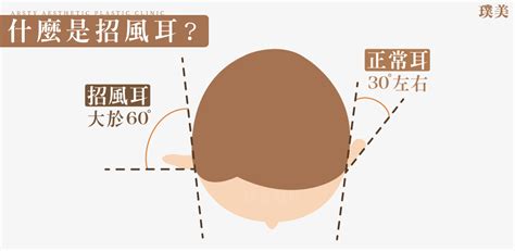 怎樣算招風耳